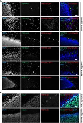 Active HHV-6 Infection of Cerebellar Purkinje Cells in Mood Disorders